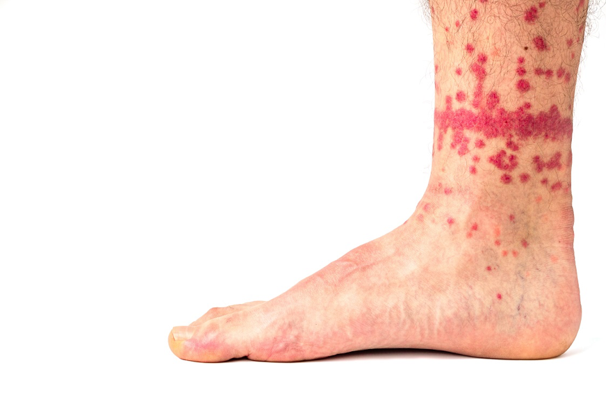 Flea bite and rash on ankle